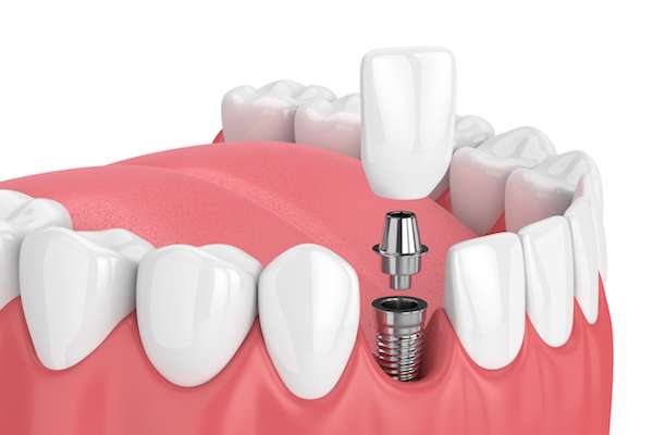 Advantages of Dental Implant treatment